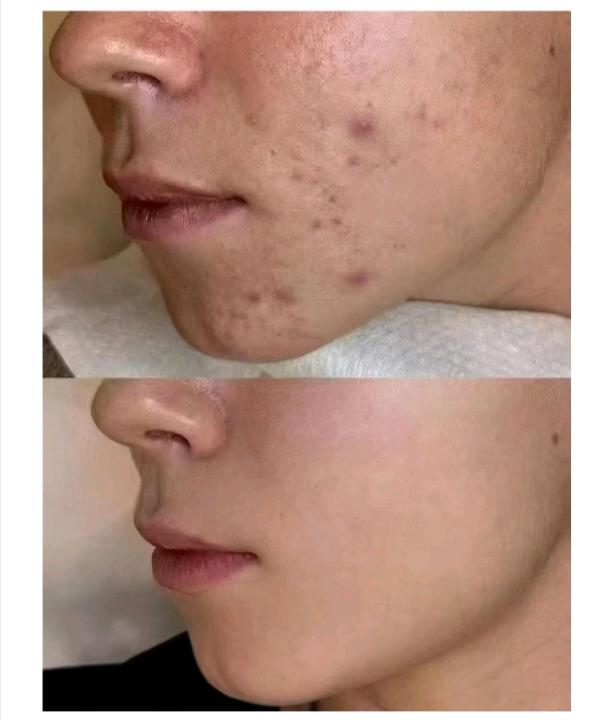 林国荛品牌货源Ai等离子嫩白抗衰