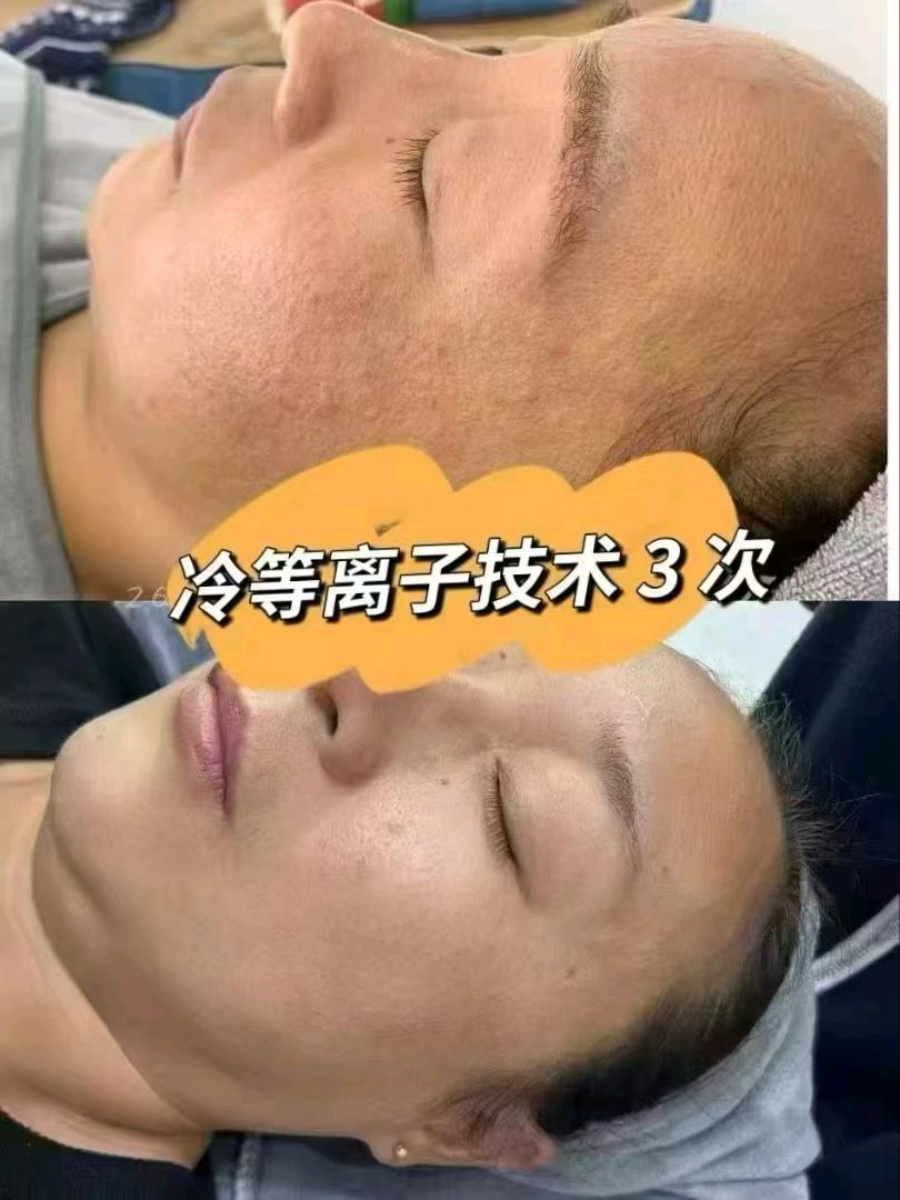 林国荛Ai等离子嫩白抗衰