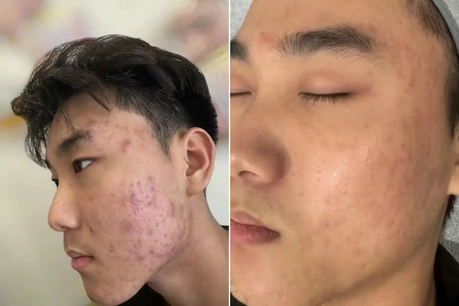 赵先生找合伙人临床实捶，这三种疗法能降低75%痘痘，痤疮复发，需要这三种疗法的联系
