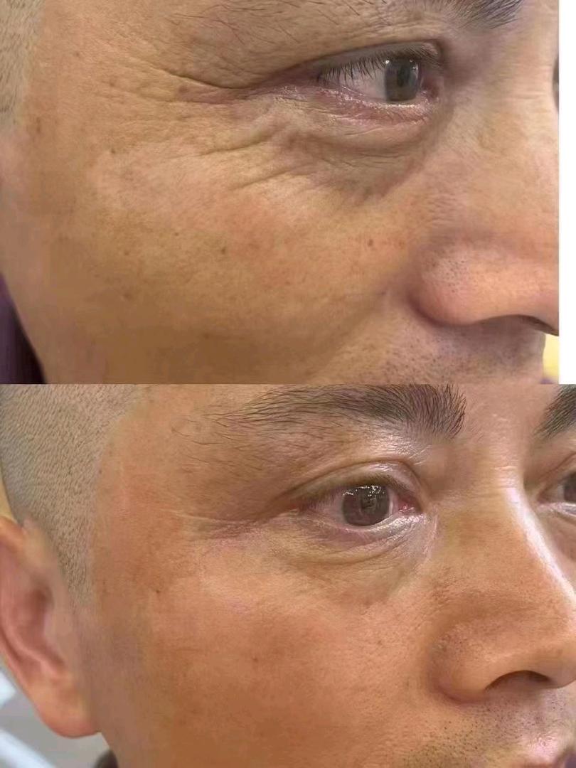 肖代锋无创眼部抗衰，599元启动，24小时拓客，月增业绩*