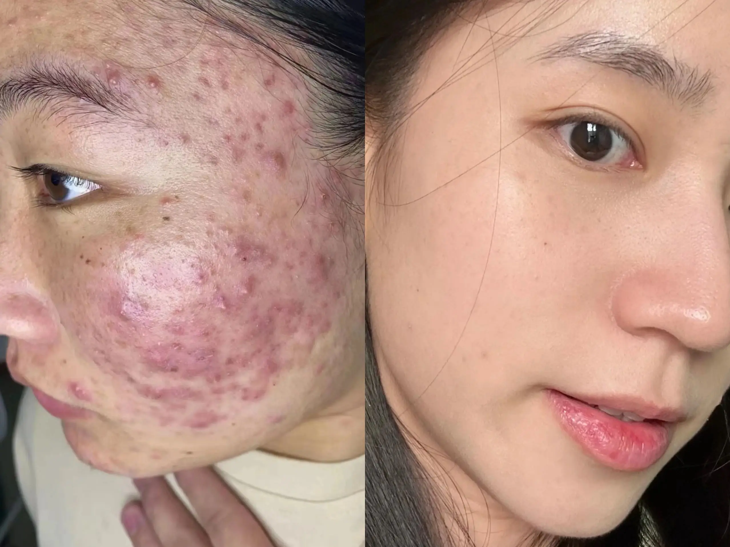 赵先生临床实捶，这三种疗法能降低75%痘痘，痤疮复发，需要这三种疗法的联系