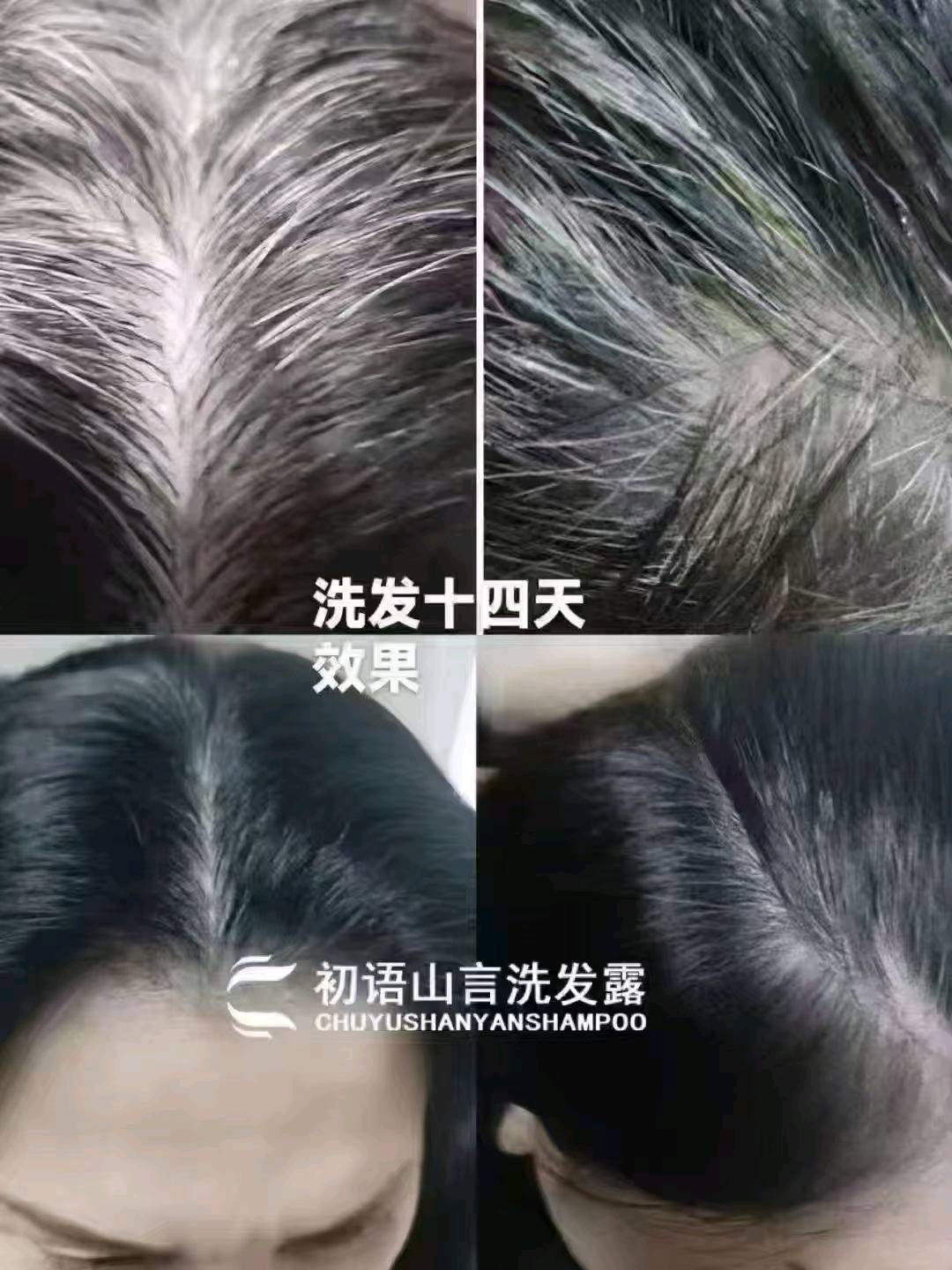 张先生解决各种头皮问题，头发7~14天白养黑实现梦想生活