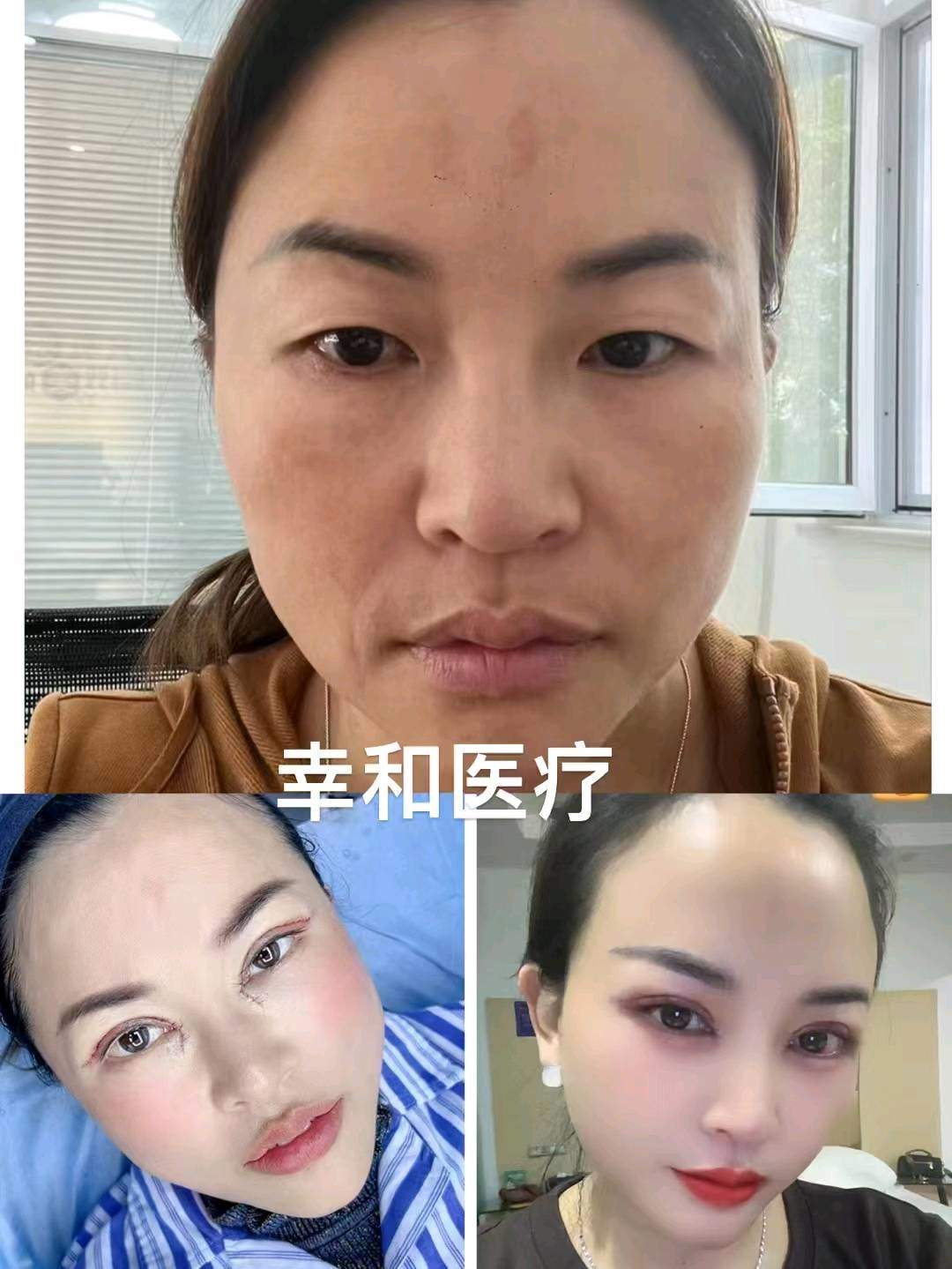 谢先生找合伙人医美整形花1000元做综合双眼皮假体鼻子，寻找用户及团队长合作