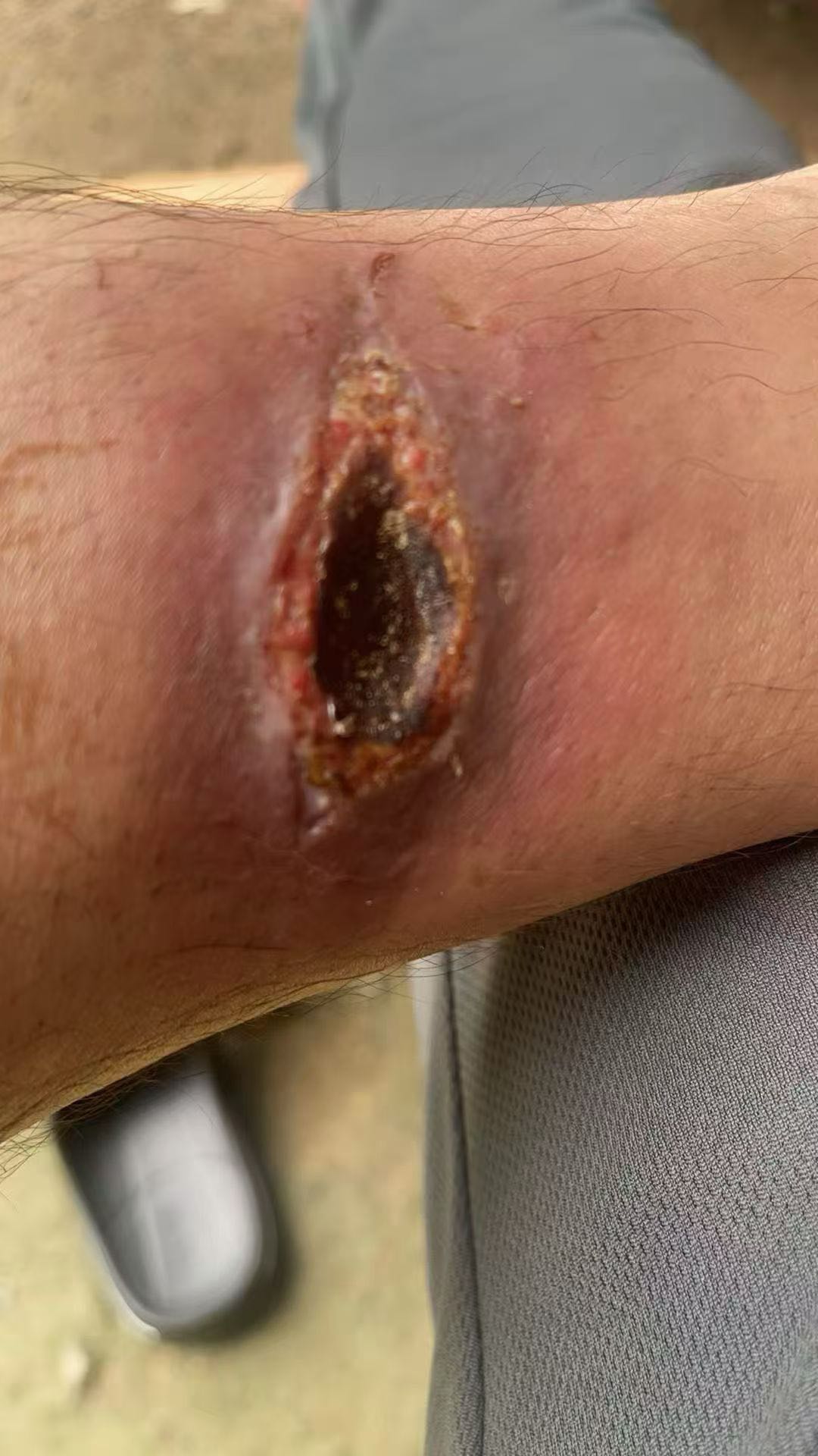 庞先生其他供需脉管炎及伤口感染综合治疗方案 - 30年草药治疗经验