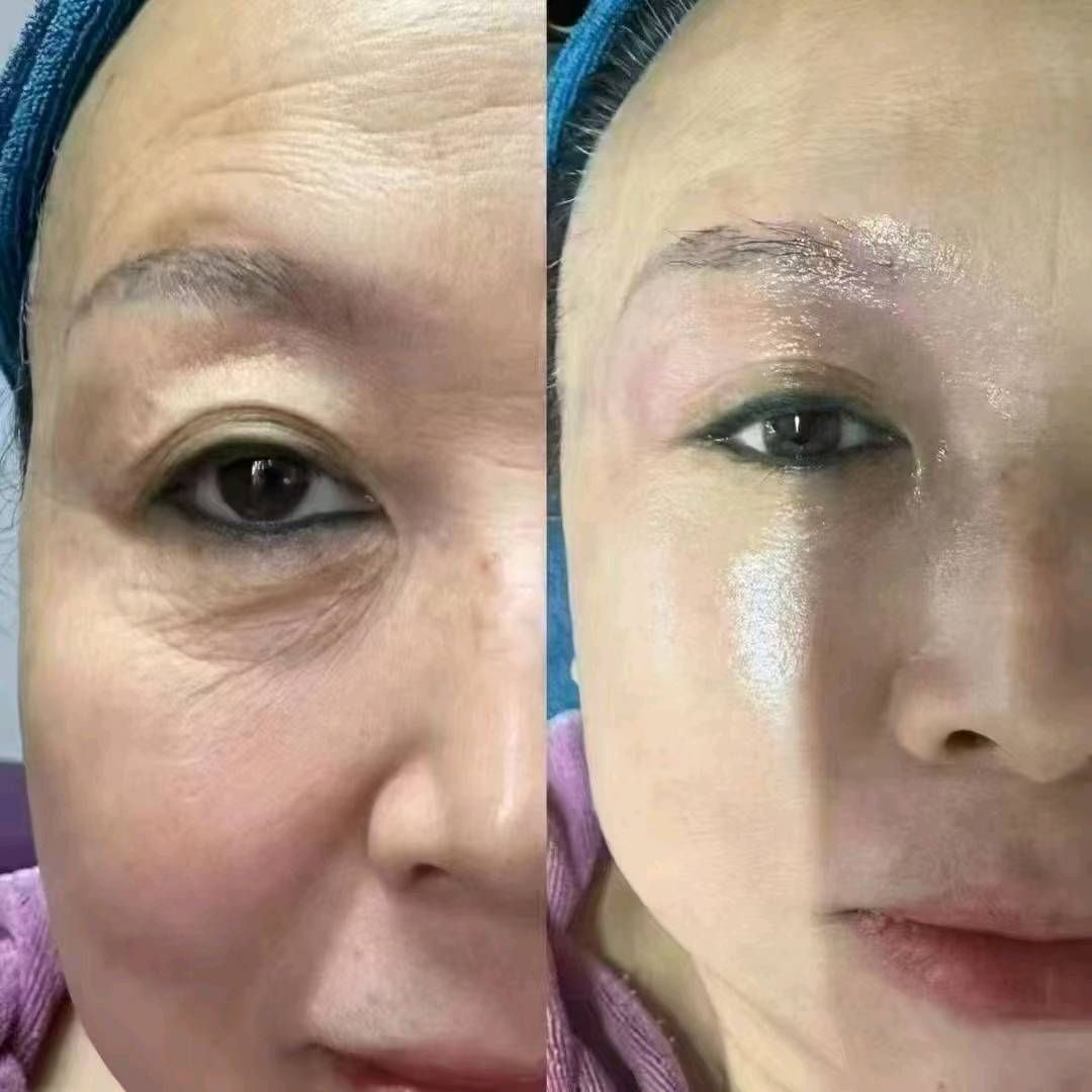 王先生其他供需建筑式抗衰美学项目合作：领先技术解决面部衰老问题