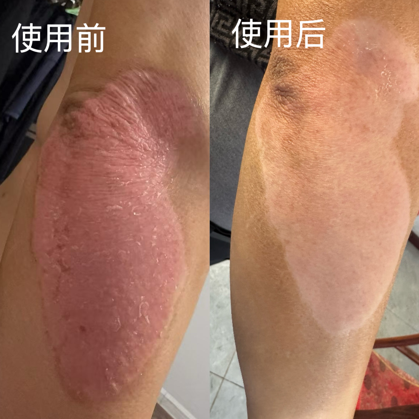 王女士找合伙人试用推广丽之泉抗菌液，告别皮肤困扰，重现健康肌肤