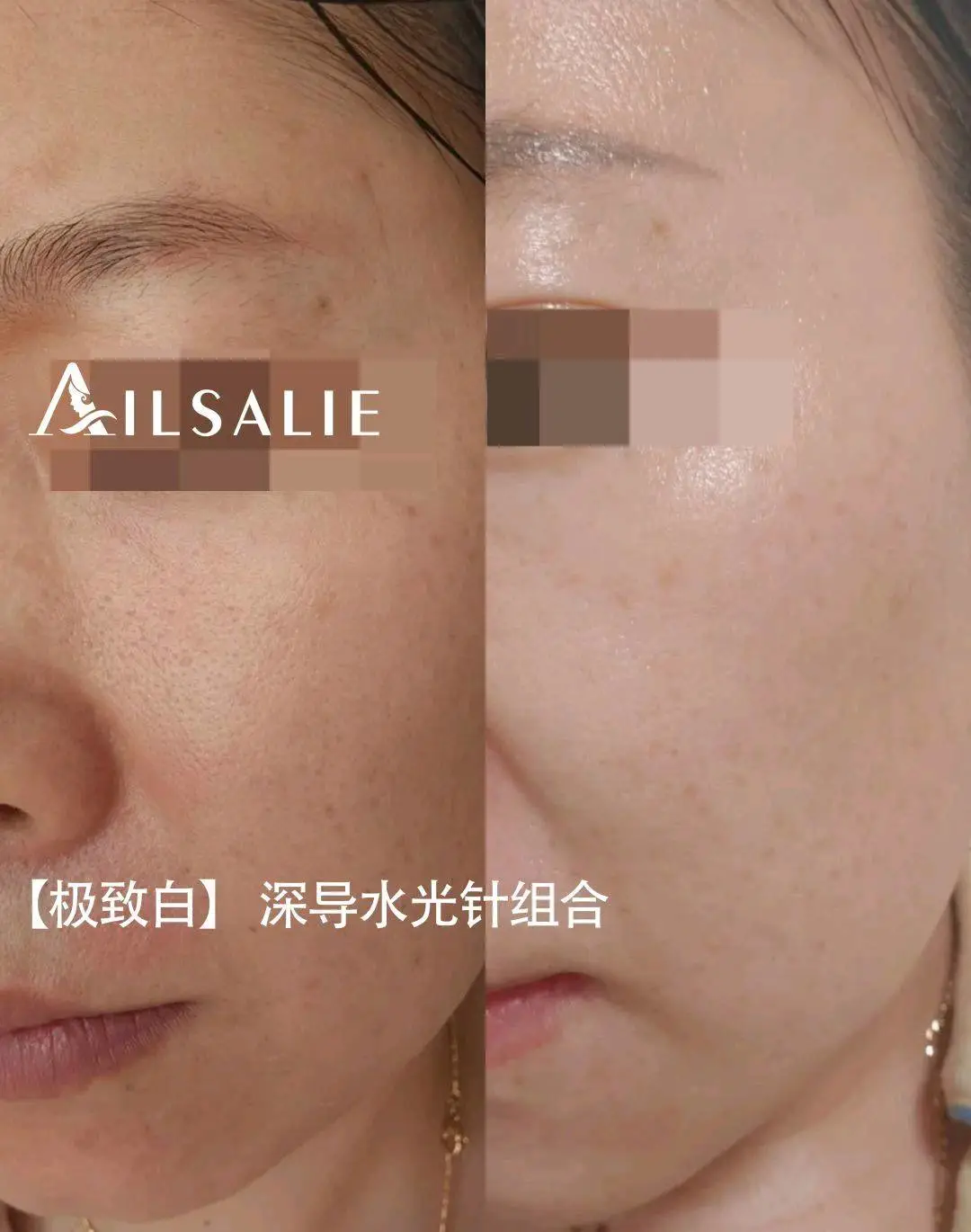 曾苏培安科娜,艾丽莎医美产品 寻找市场人81%