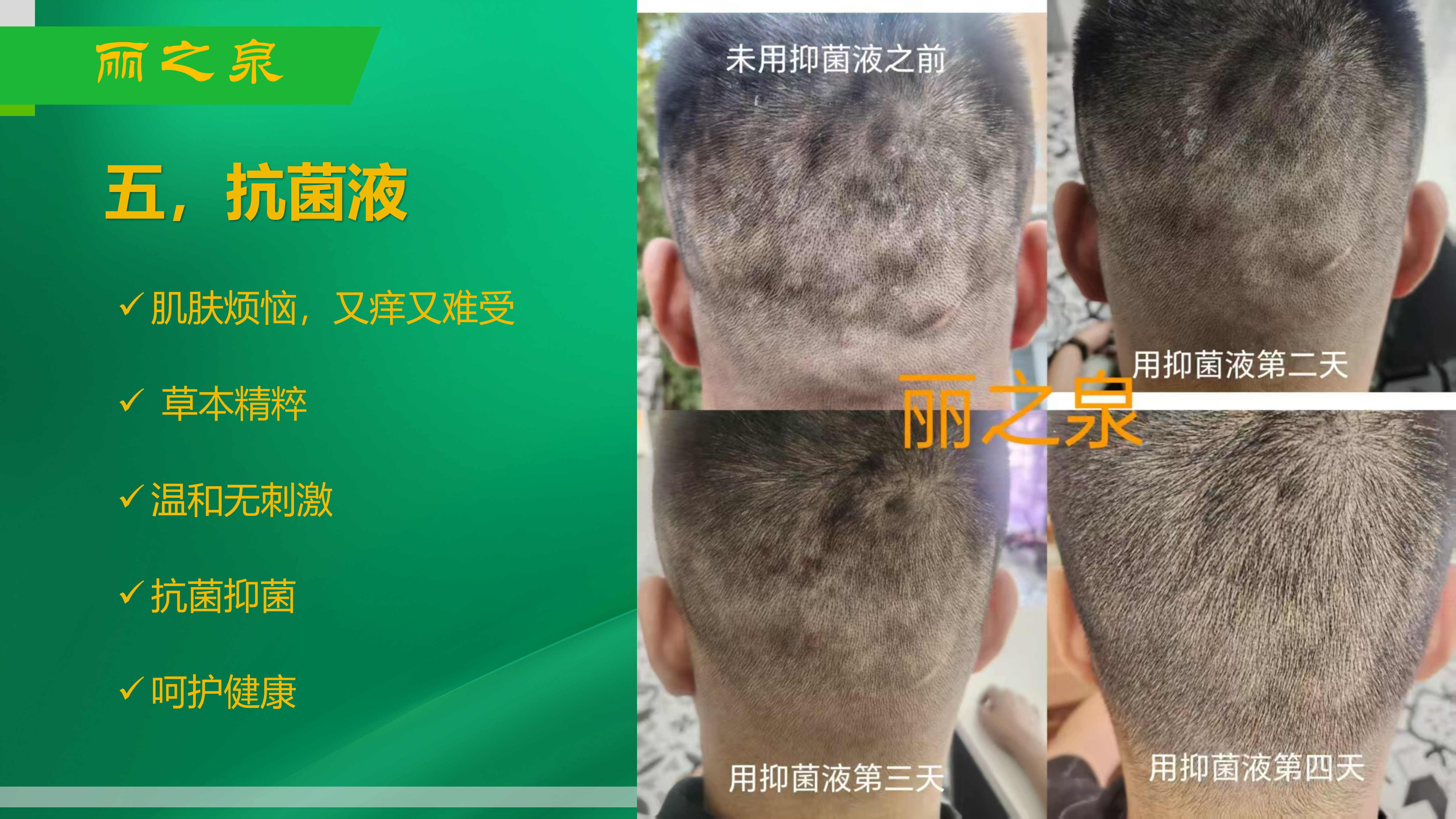 王女士试用推广丽之泉抗菌液，告别皮肤困扰，重现健康肌肤