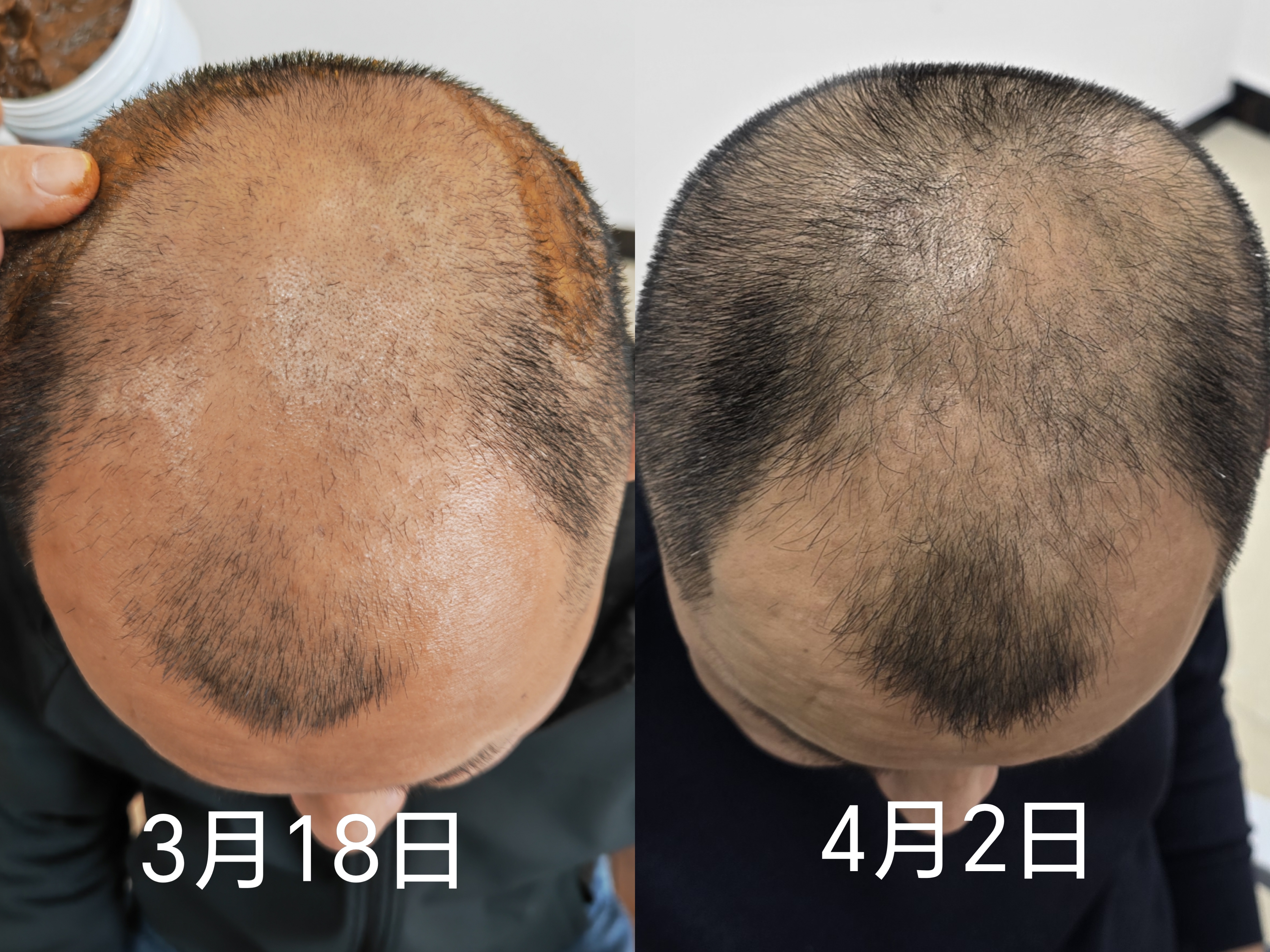 石志路找合伙人老皇药生发项目：无创业风险，签约生发99%长出头发*，10天