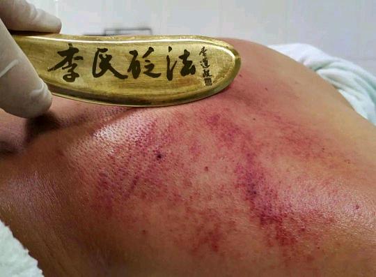 郭先生义乌本地专业刮痧/艾灸/肩颈调理,上门服务,寻理发店/健身房/养生馆